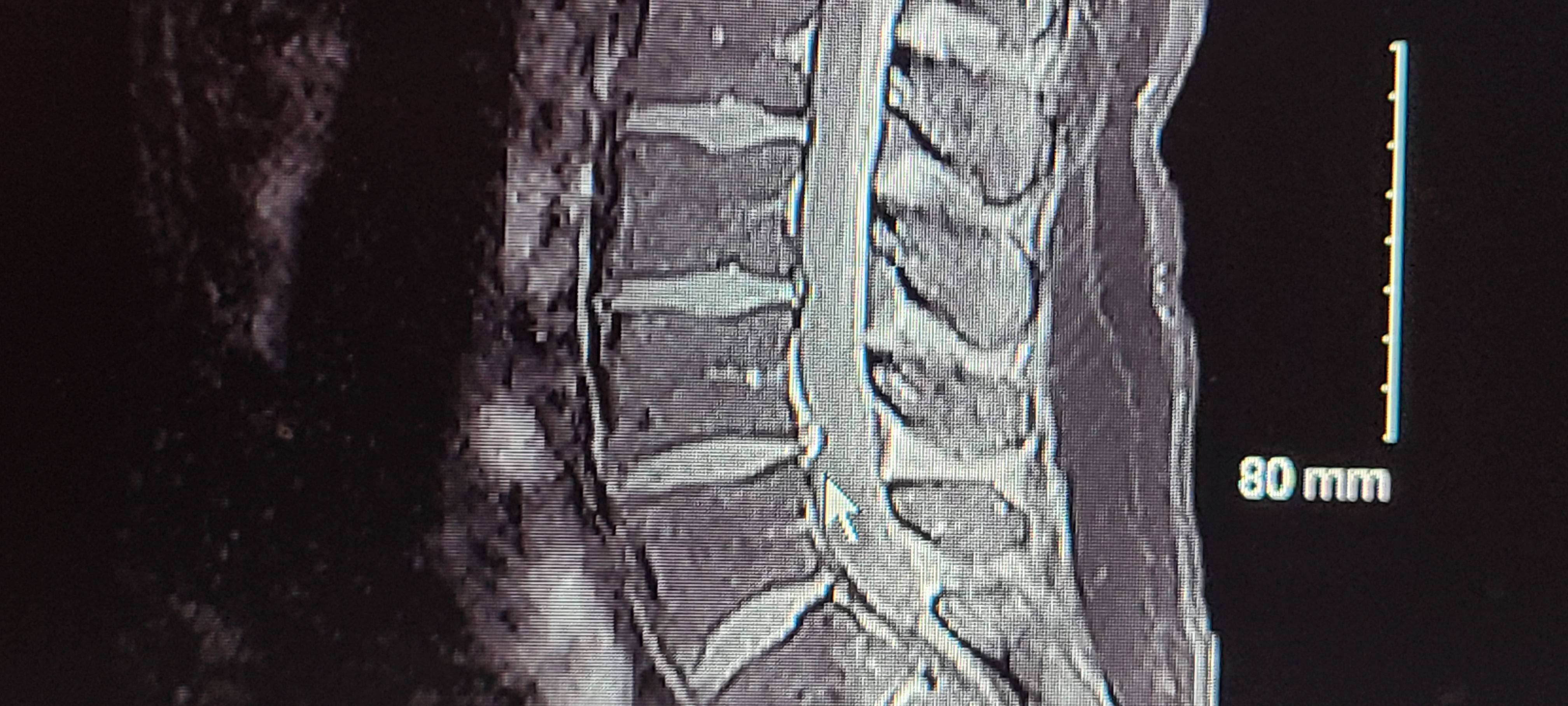 Post MRI Lumbar